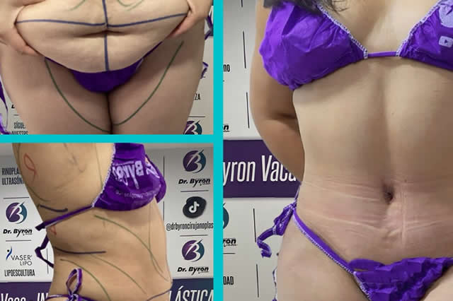 RESULTADOS LIPOVASER EN QUITO